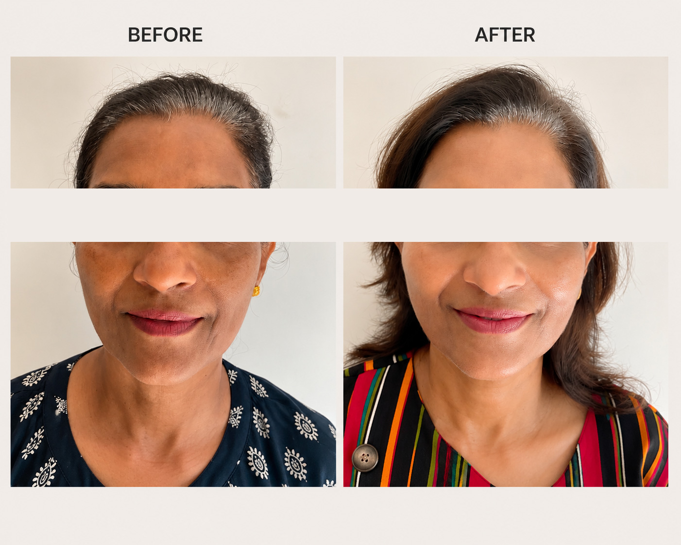 Skin Boosters Result