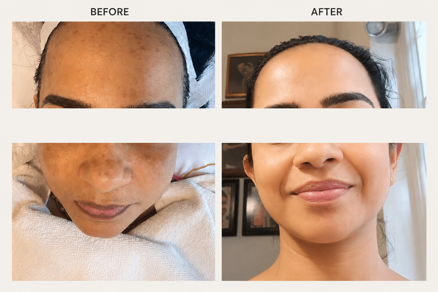 Chemical Peels Result